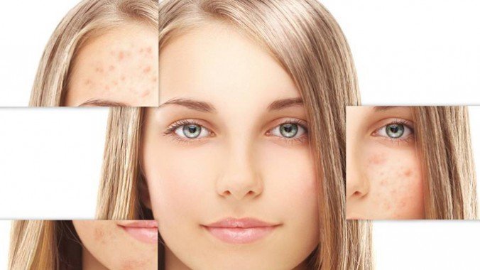 Acne Treatment