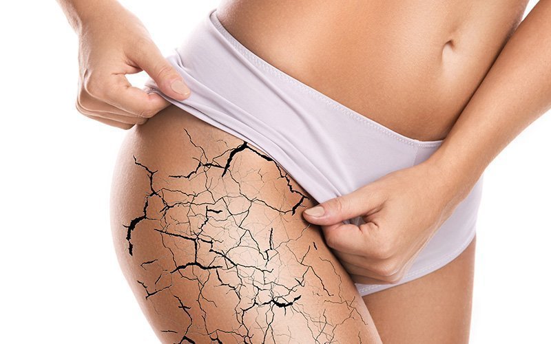 Stretch Mark Treatment